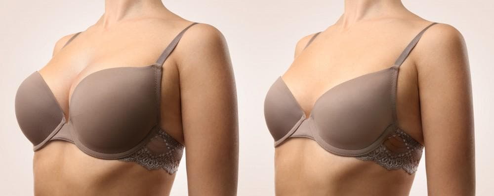 Bauchdeckenstraffung nach Schwangerschaft: Wie die Operation zu einem flacheren Bauch verhelfen kann