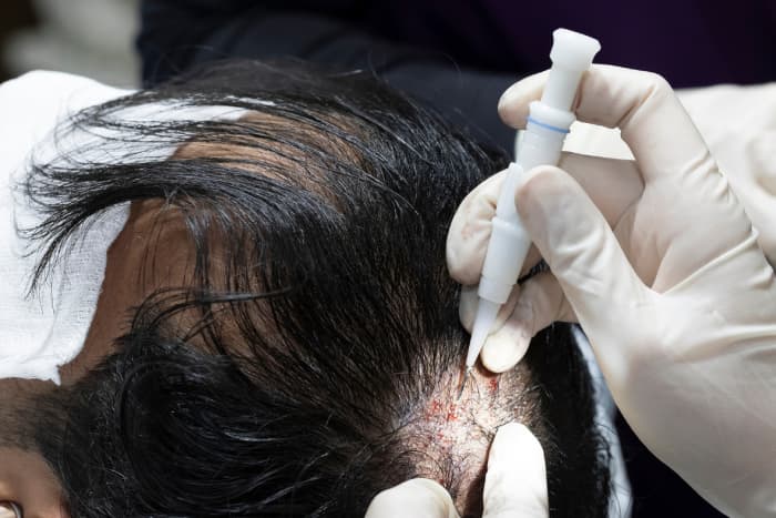 Maßgeschneiderte Behandlungen für Haarausfall in Nürnberg